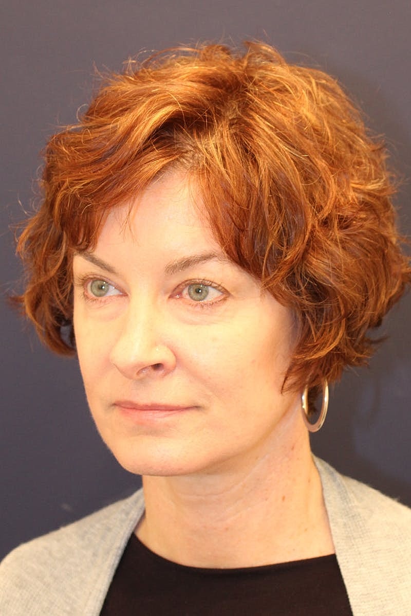 Neck Lift Before & After