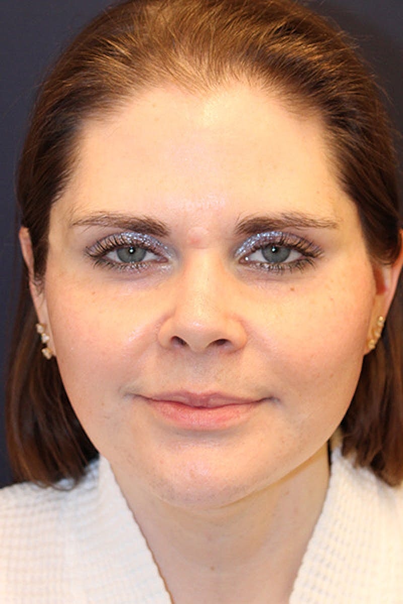 Neck Lift Before & After