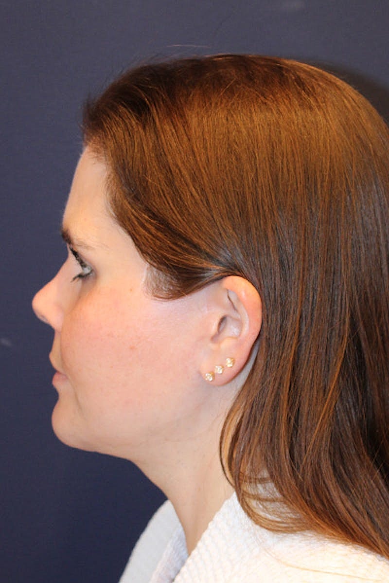 Neck Lift Before & After