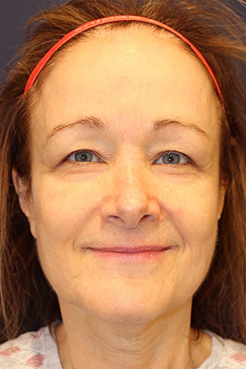 Neck Lift Before & After