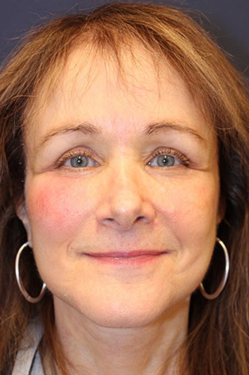 Neck Lift Before & After