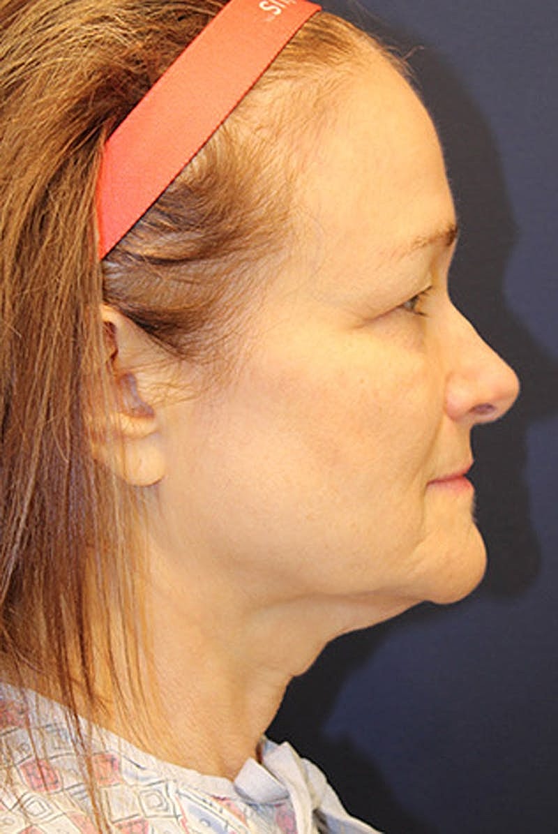 Neck Lift Before & After