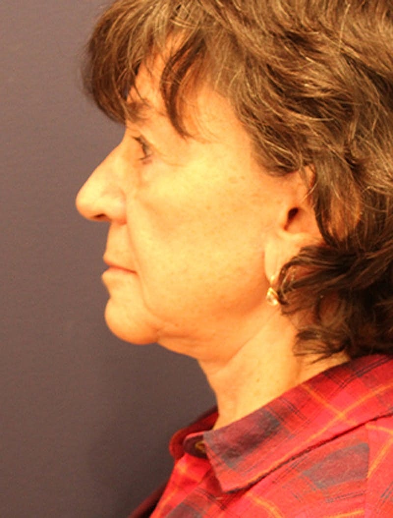 Neck Lift Before & After