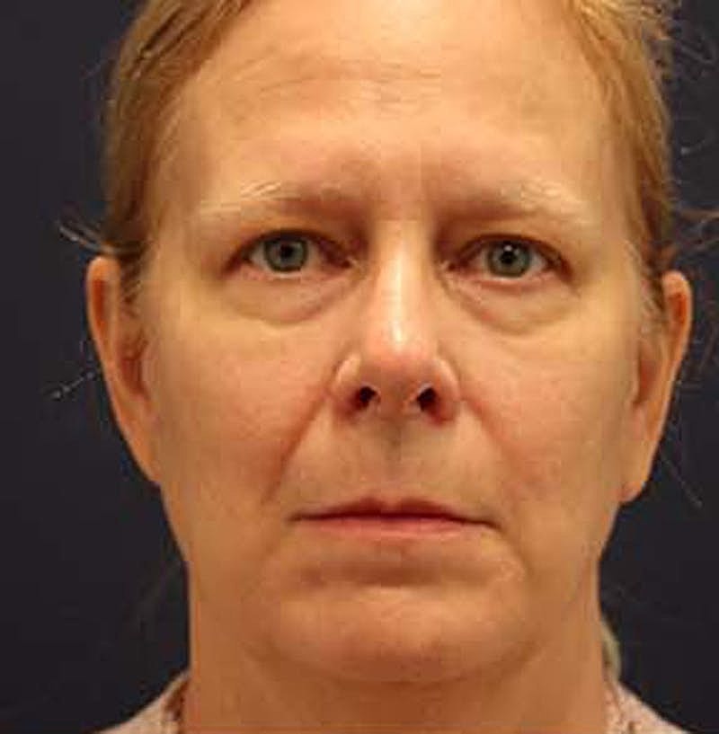 Neck Lift Before & After