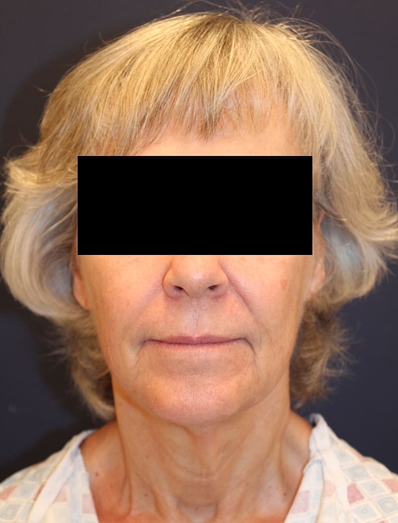 Neck Lift Gallery Before & After