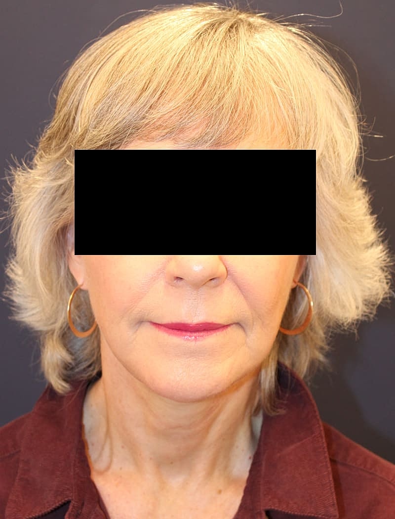 Neck Lift Gallery Before & After