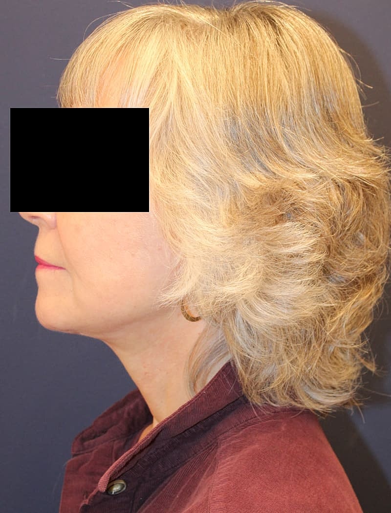 Neck Lift Gallery Before & After
