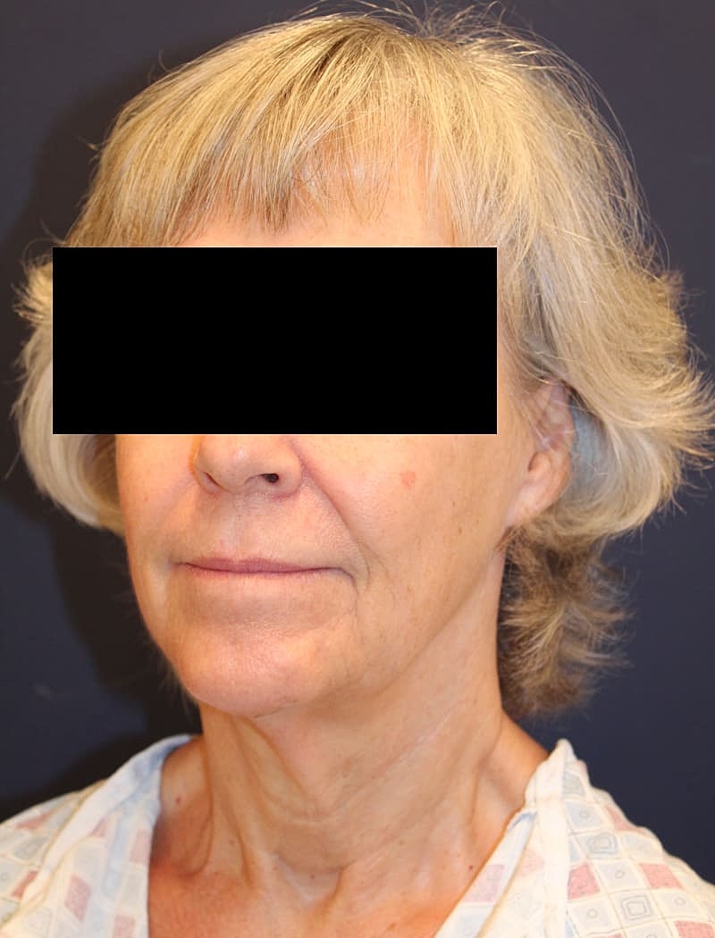 Neck Lift Gallery Before & After