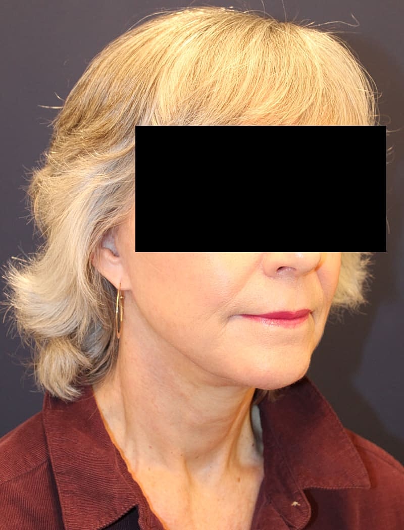 Neck Lift Gallery Before & After