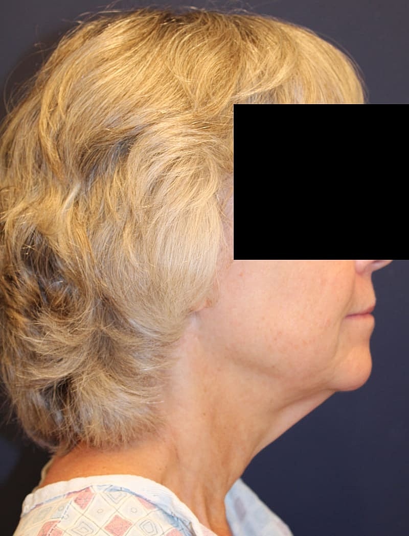 Neck Lift Gallery Before & After