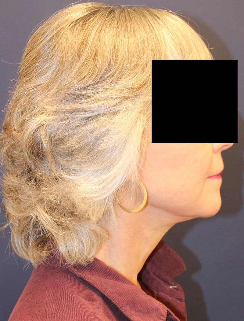 Neck Lift Gallery Before & After
