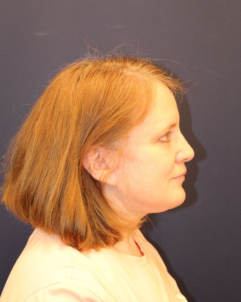 Profile view of a woman with medium hair.