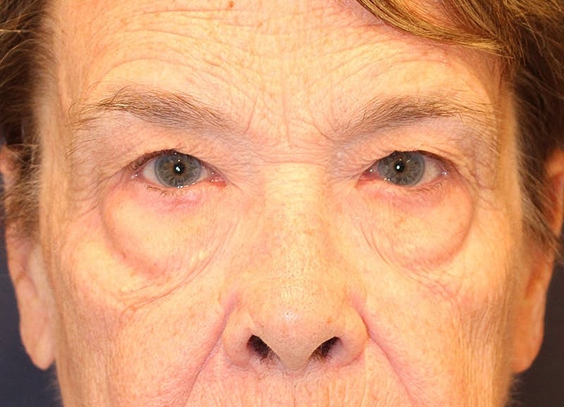 Brow Lift Before & After