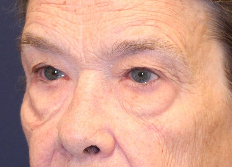 Brow Lift Before & After