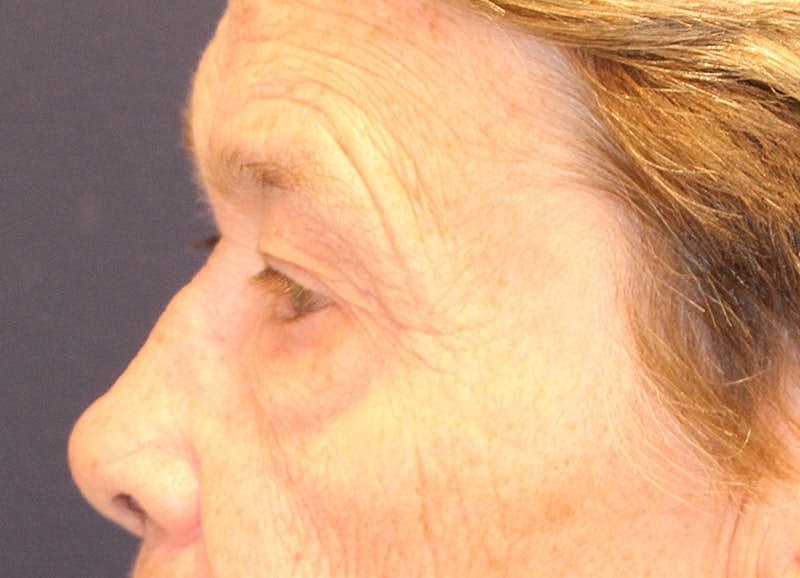 Brow Lift Before & After