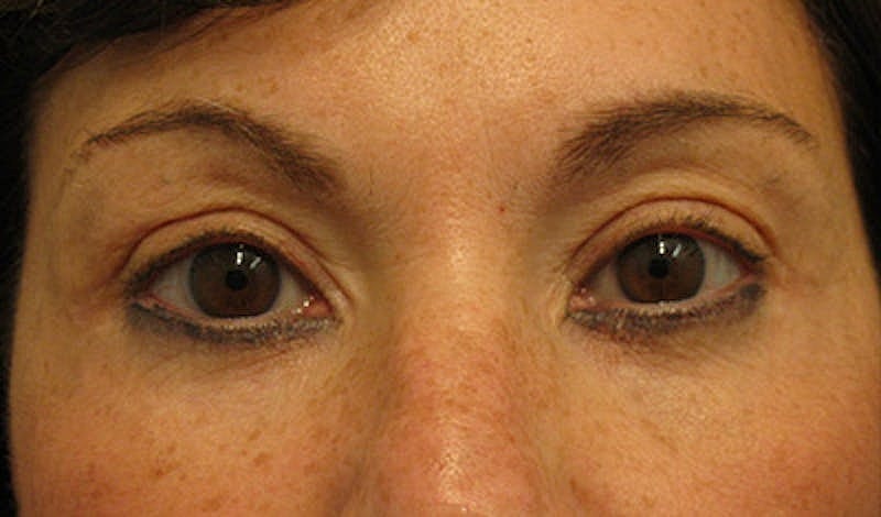 Brow Lift Before & After