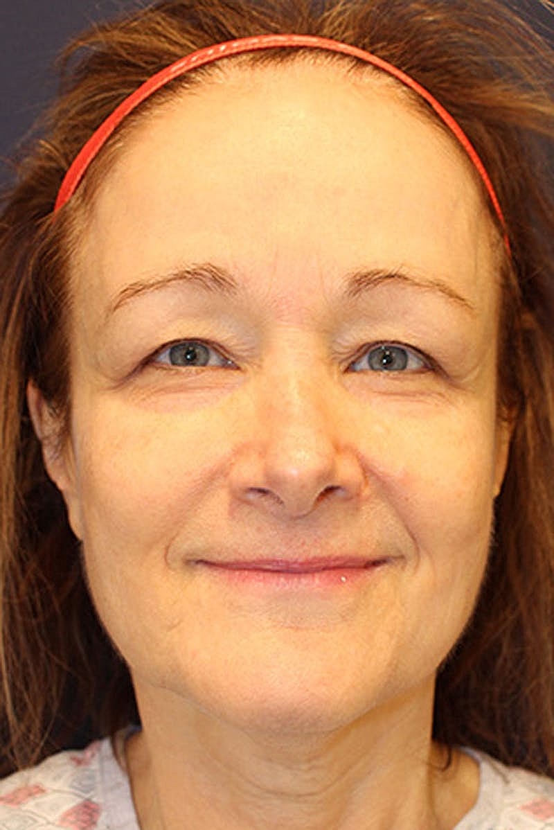 Brow Lift Before & After