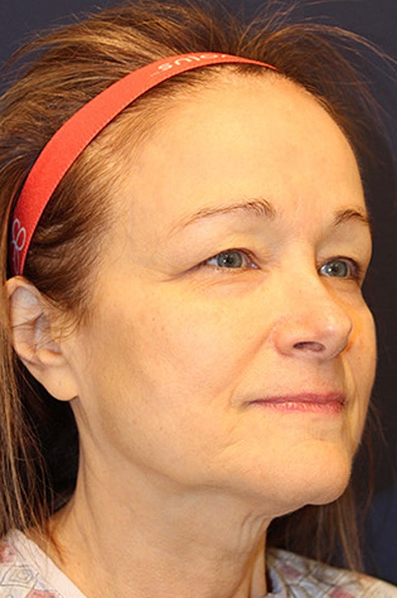 Brow Lift Before & After