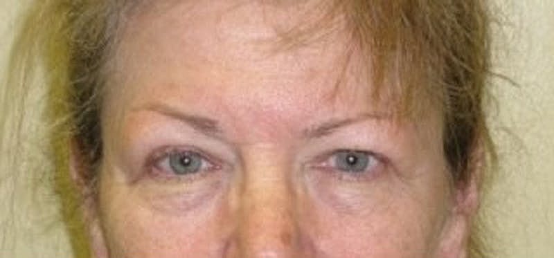 Brow Lift Before & After