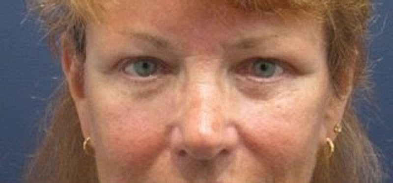 Brow Lift Before & After