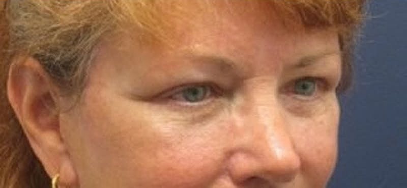 Brow Lift Before & After