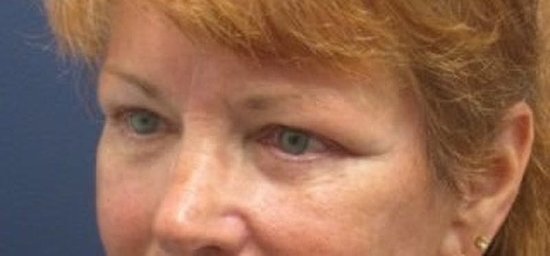 Brow Lift Before & After