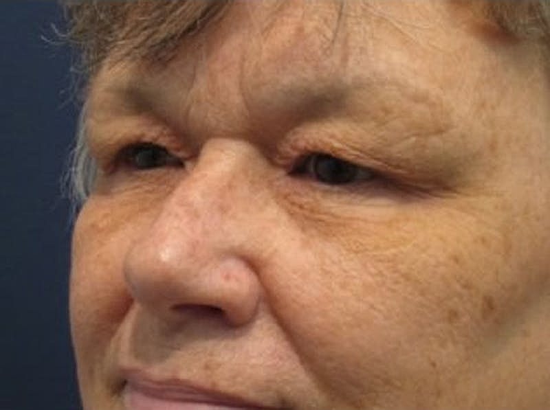 Brow Lift Before & After