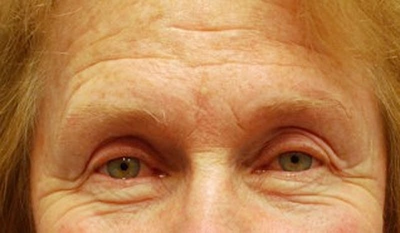 Brow Lift Before & After