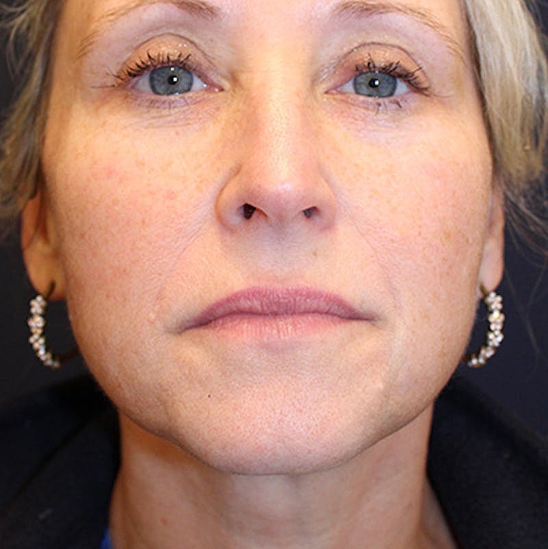 Injectables Before & After
