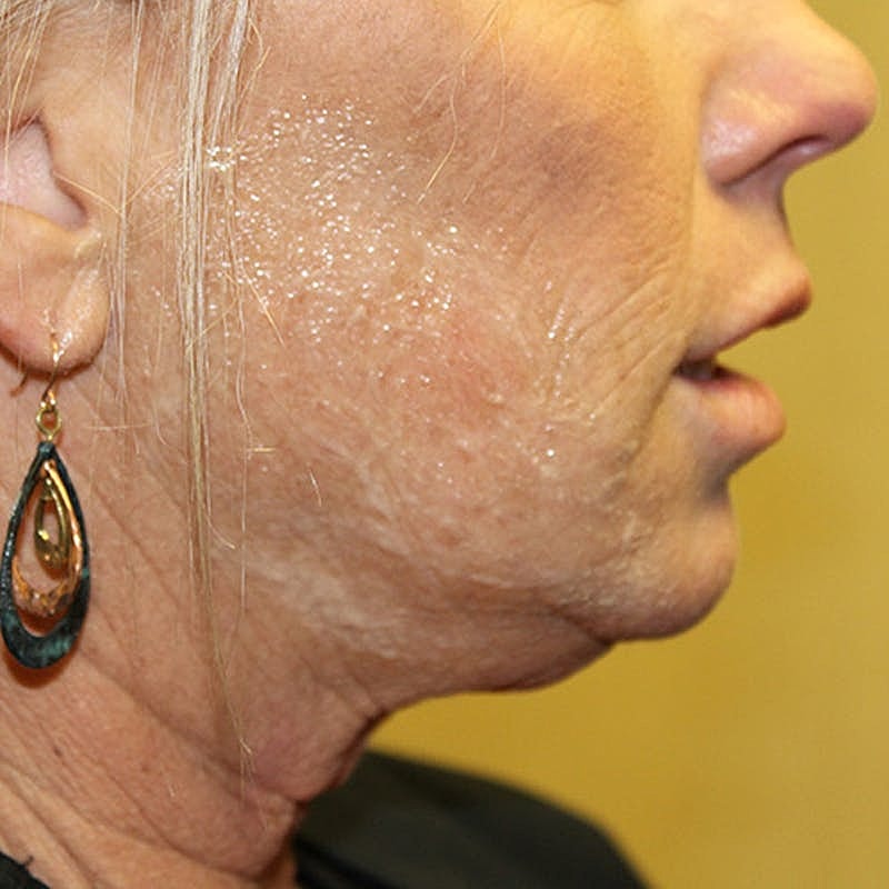 Injectables Before & After