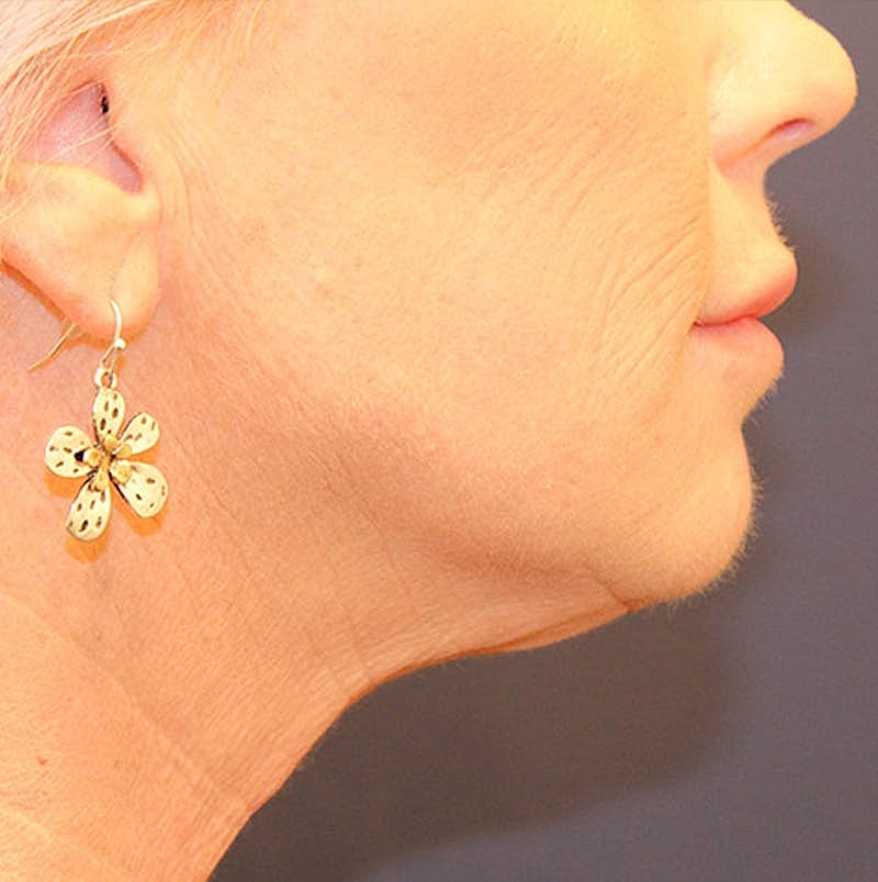 Injectables Before & After