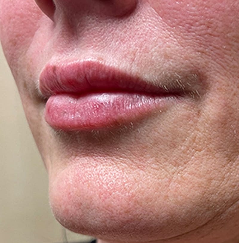 Injectables Before & After