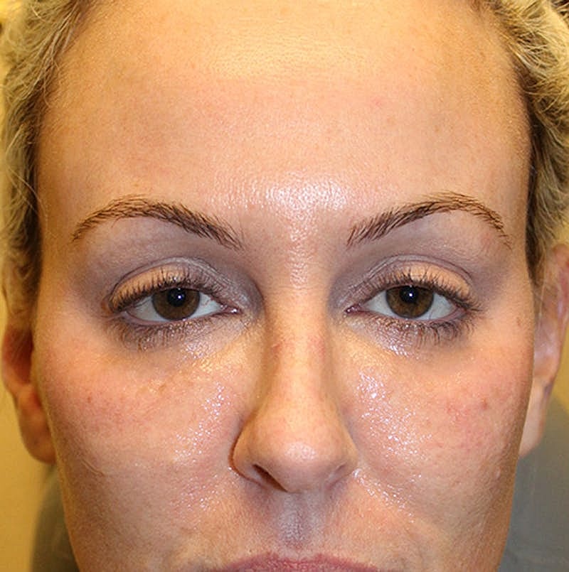 Injectables Before & After