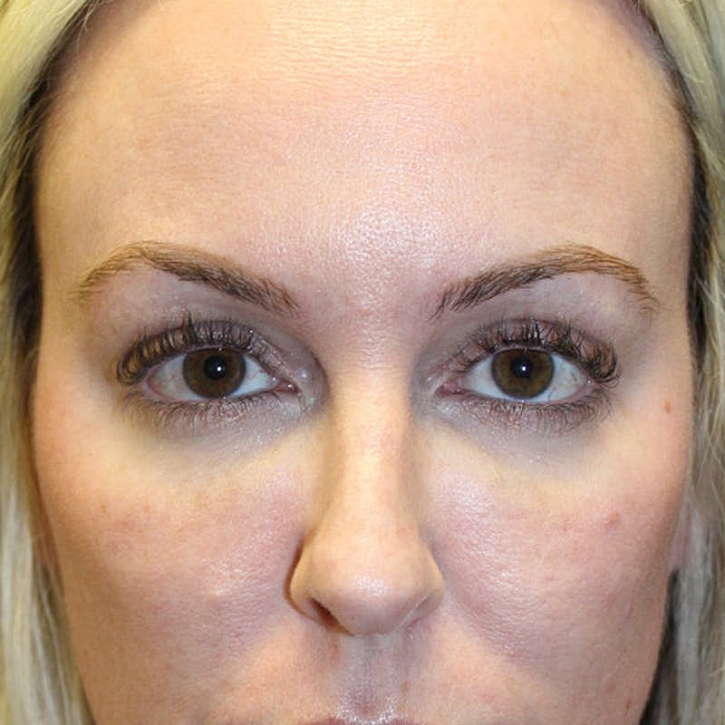 Injectables Before & After