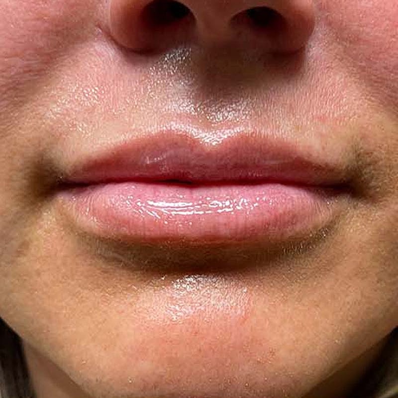 Injectables Before & After