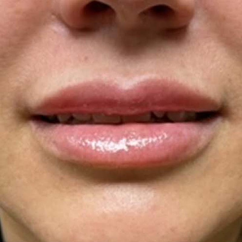 Injectables Before & After