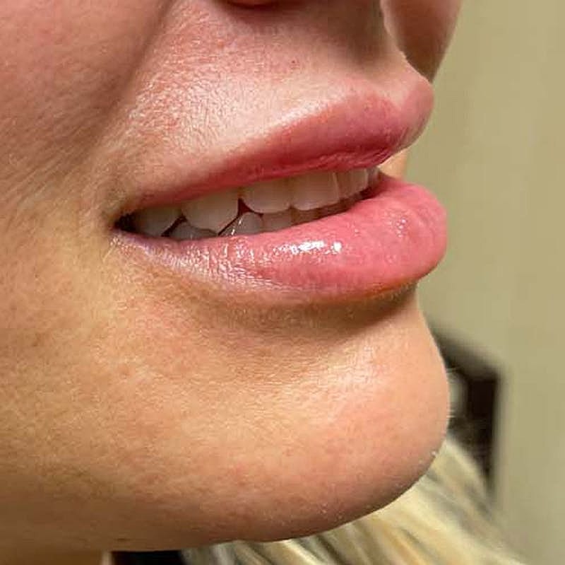 Injectables Before & After