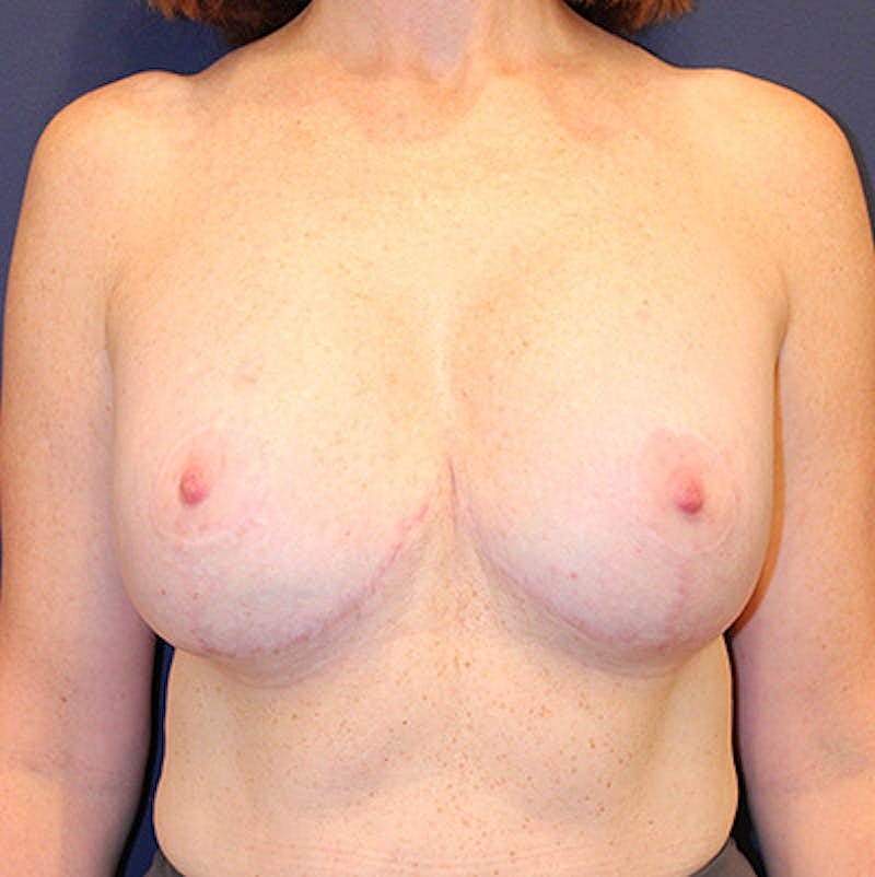 Breast Lift With Augmentation Before & After