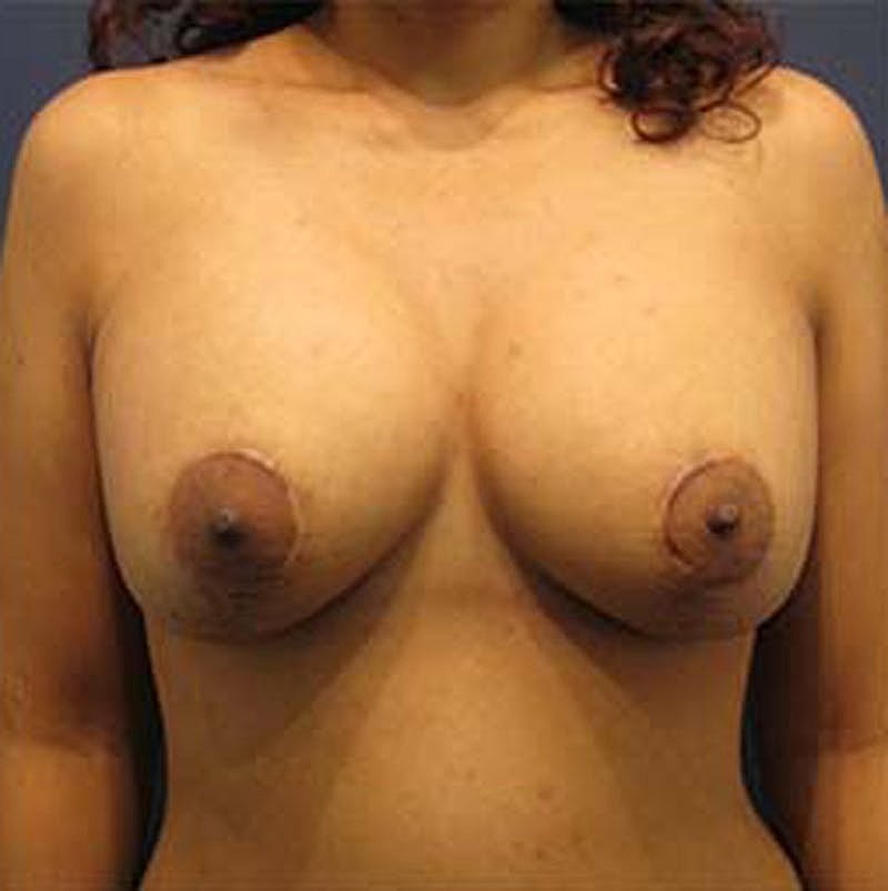 Breast Lift With Augmentation Before & After