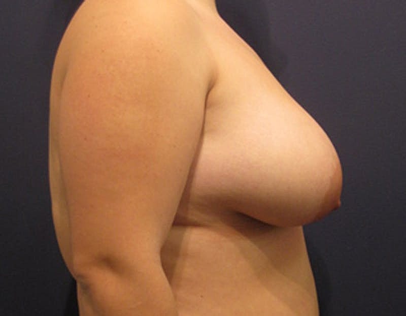 Breast Lift With Augmentation Before & After