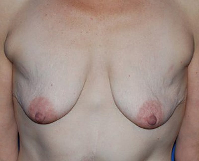 Breast Lift With Augmentation Before & After