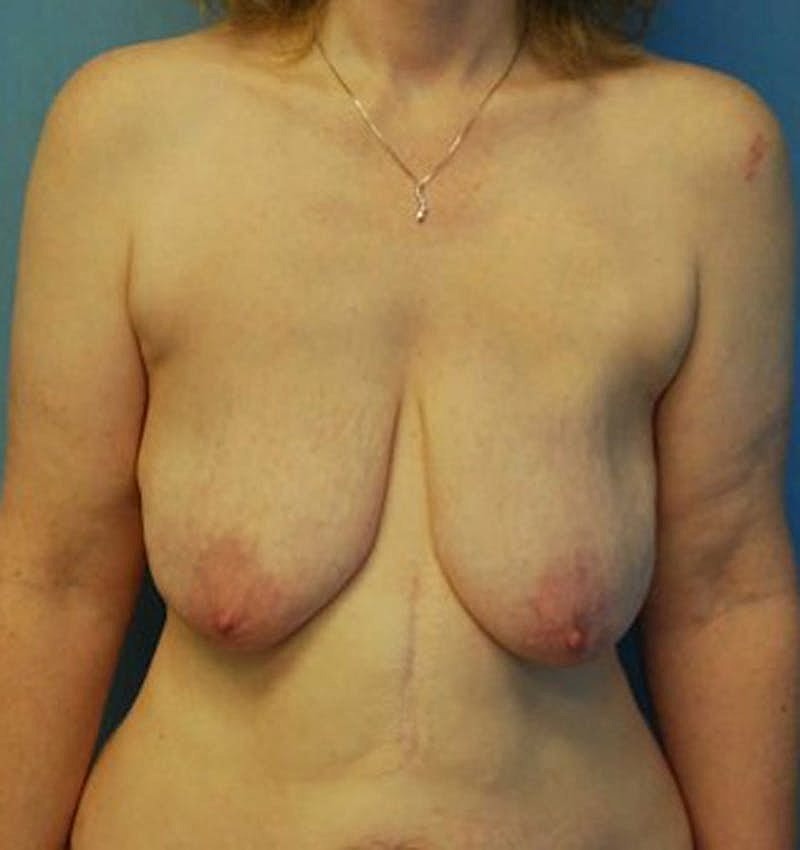 Breast Lift With Augmentation Before & After