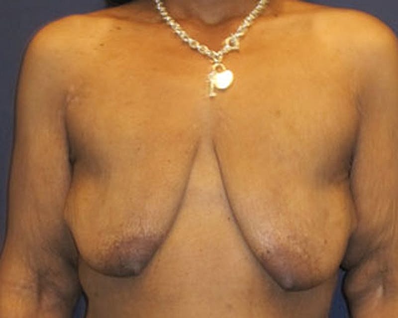 Breast Lift With Augmentation Before & After