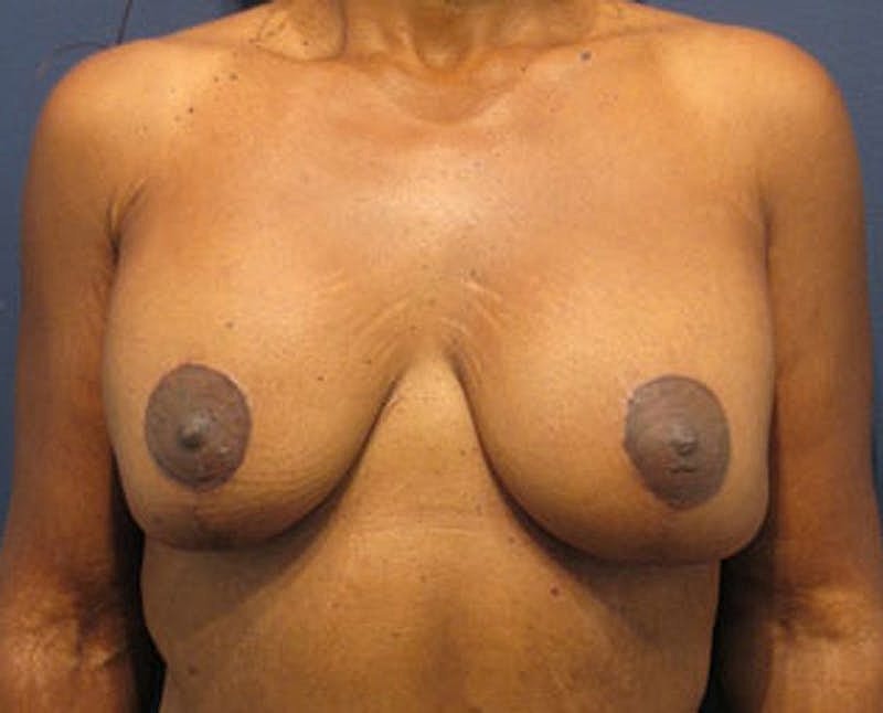 Breast Lift With Augmentation Before & After