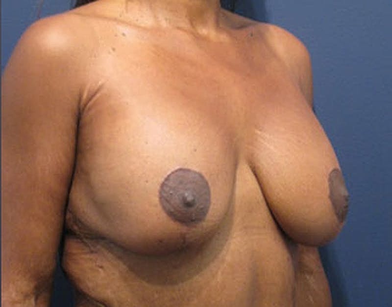 Breast Lift With Augmentation Before & After