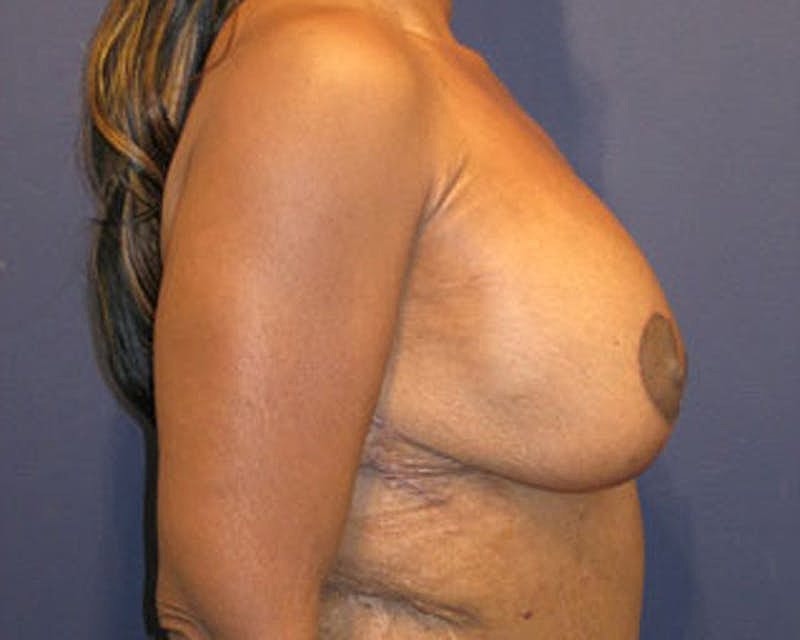 Breast Lift With Augmentation Before & After