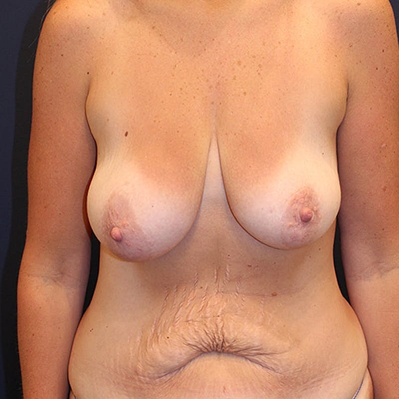 Breast Lift With Augmentation Before & After