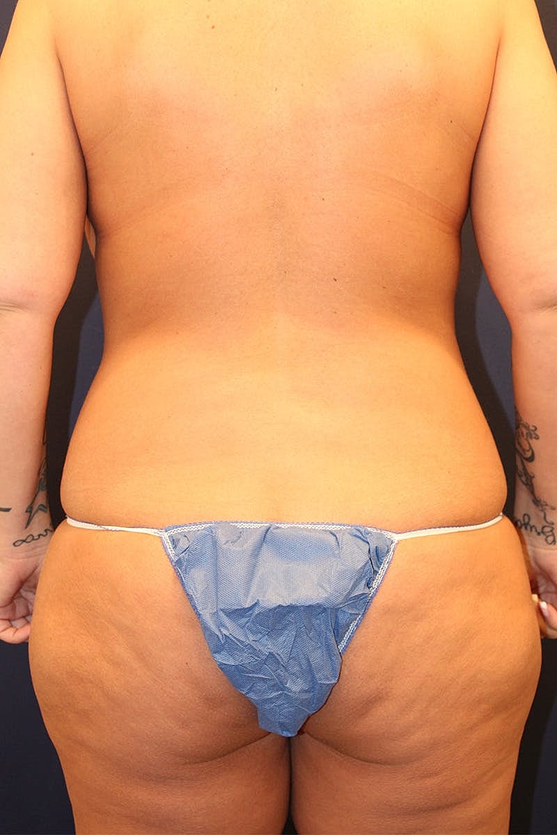 Mommy Makeover Before & After