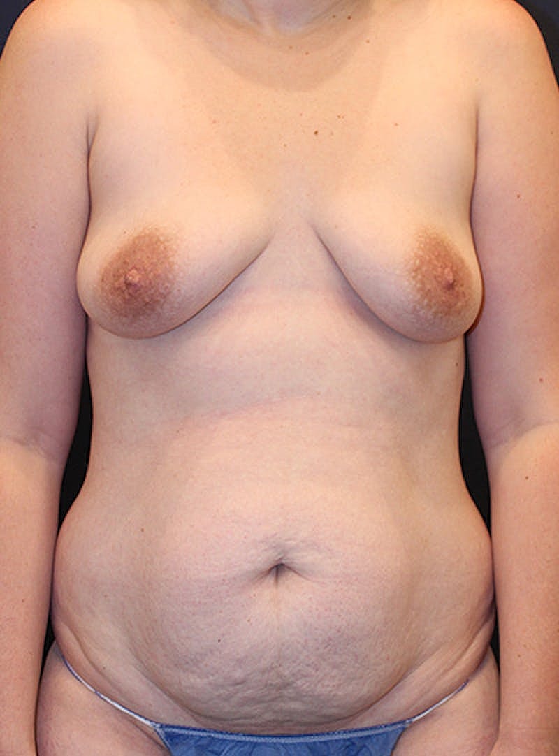 Mommy Makeover Before & After