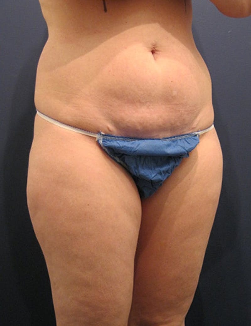 Mommy Makeover Before & After